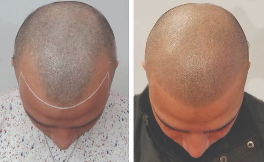 SMP Hair Treatments: A Permanent Solution to Hair Loss
