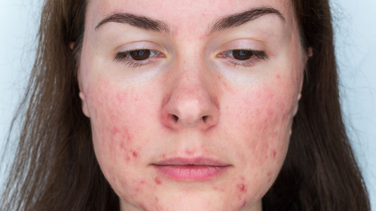 Unlocking Comfort: The Ultimate Guide to Rosacea Creams