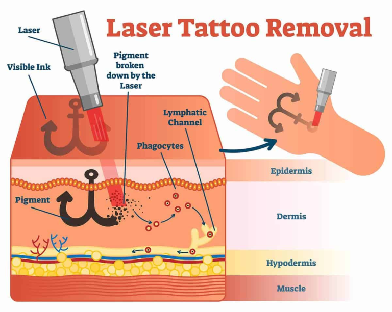 Inked and Employed: How Tattoo Removal Impacts Career Opportunities