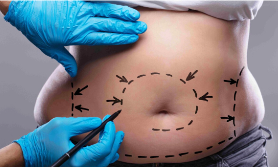 Facelifts to Tummy Tucks Understanding the Most Common Cosmetic Surgeries