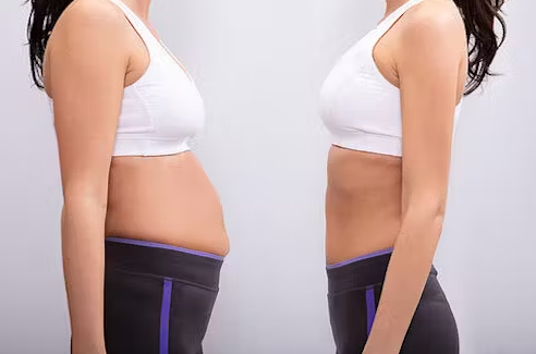 Tummy Tuck vs. Liposuction – Which Procedure is Best for You?