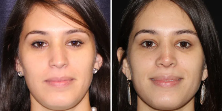 Is Nose Surgery the Solution to Your Breathing Problems?