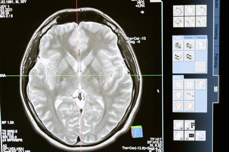 Everything To Know About Glioblastoma