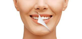 Smile Makeovers: Combining Implants With Cosmetic Enhancements