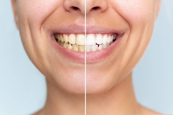 How Dentists Address Staining Caused By Medications Or Developmental Changes