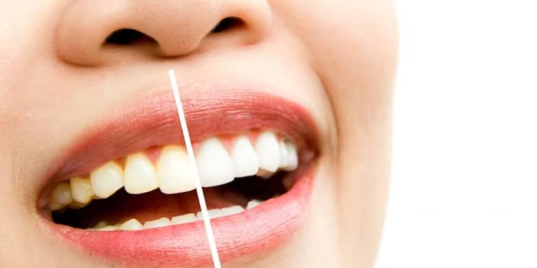 6 Questions To Ask About Treating Intrinsic Tooth Stains