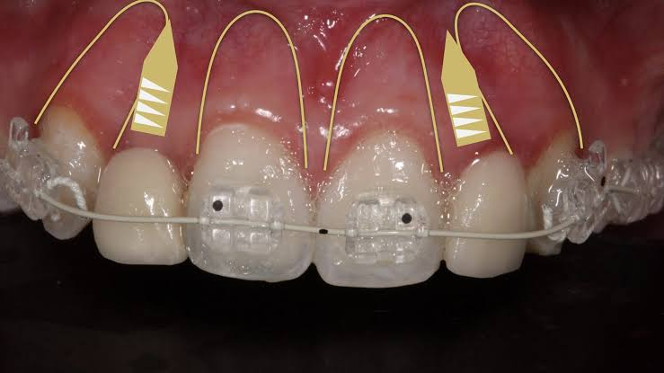 How Dental Implants Help Correct Spacing And Proportion Issues