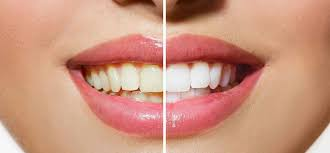 Cosmetic Solutions For Teeth That Look Uneven After Natural Wear